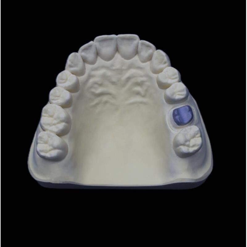 Post And Core Dental Inlay Core For Enhanced Tooth Stability Restoration Anchorage