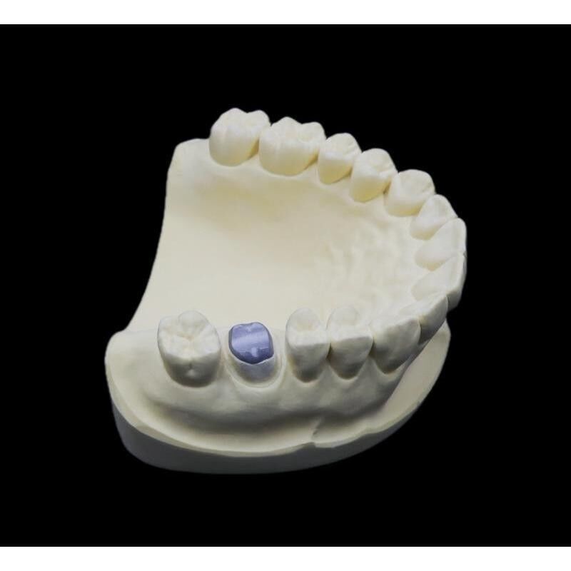 Post And Core Dental Inlay Core For Enhanced Tooth Stability Restoration Anchorage
