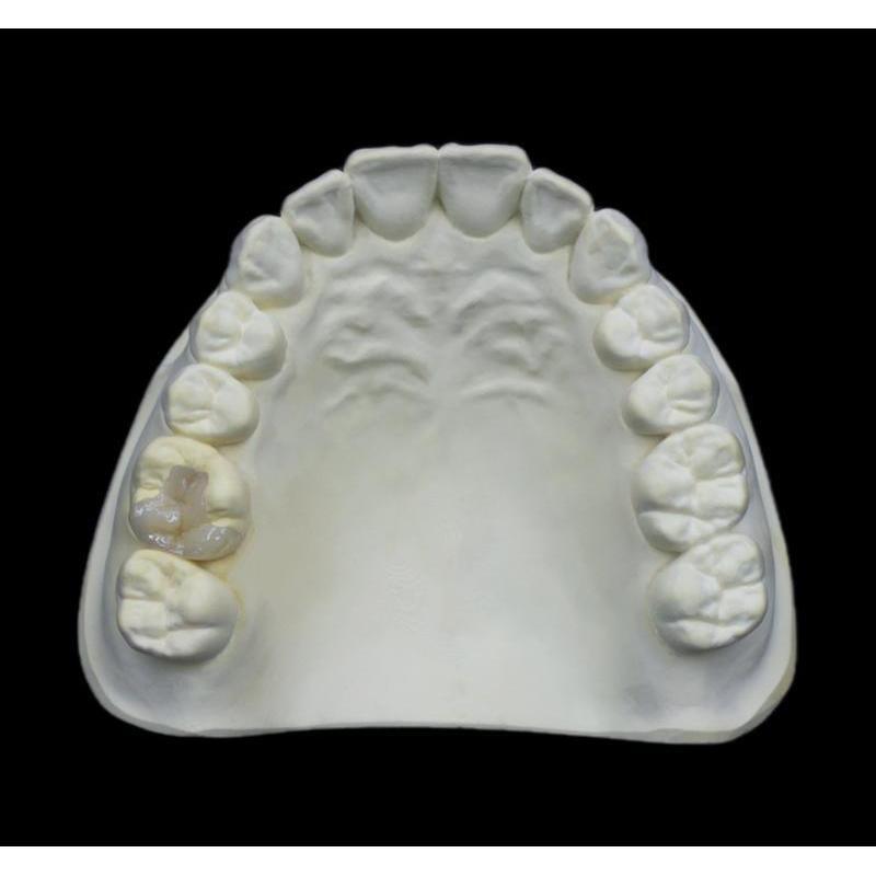 Long Lasting Tooth Colored Dental Inlay And Onlay Wear Resistance Tooth Restoration