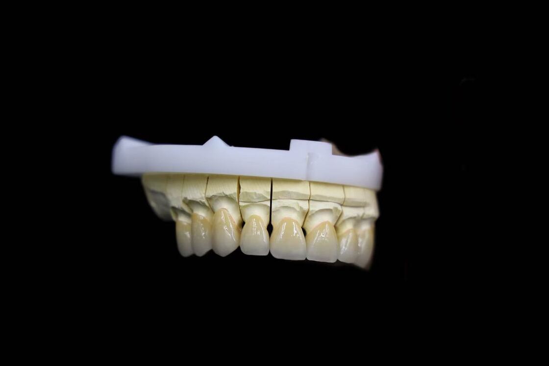 Abutment Supported Porcelain Fused To Metal Crown PFM Crown Biocompatible Restoration