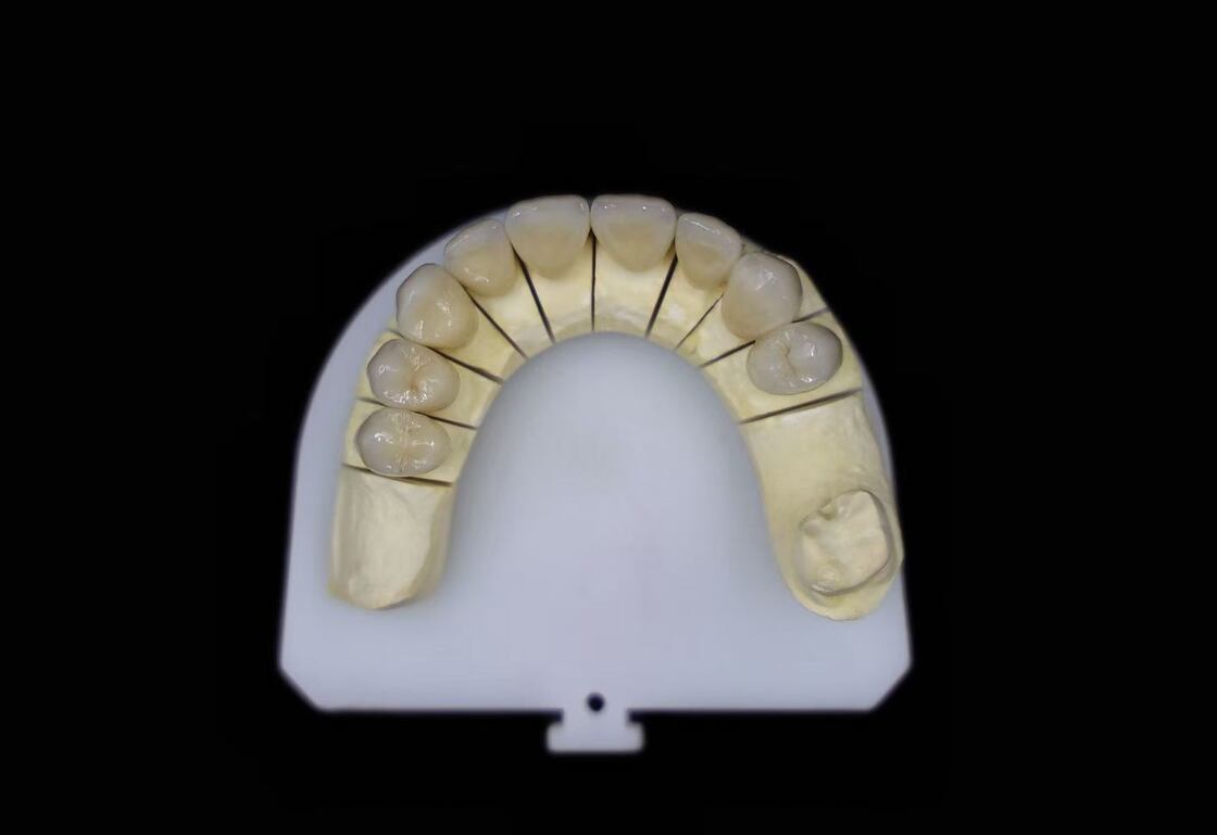 Abutment Supported Porcelain Fused To Metal Crown PFM Crown Biocompatible Restoration