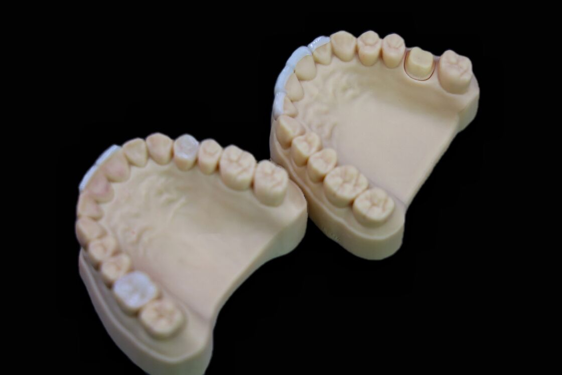 Minimally Invasive Dental Veneer Porcelain Teeth HT MT LT MO Dental Laboratory China