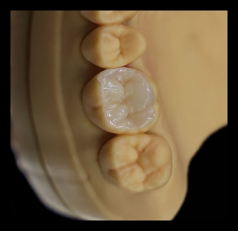 China Dental Lab Emax Inlay Lithium Disilicate CE Marked Heat Pressed Dental Inlay