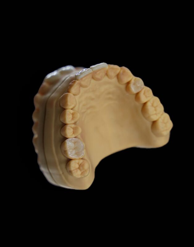 China Dental Lab Emax Inlay Lithium Disilicate CE Marked Heat Pressed Dental Inlay
