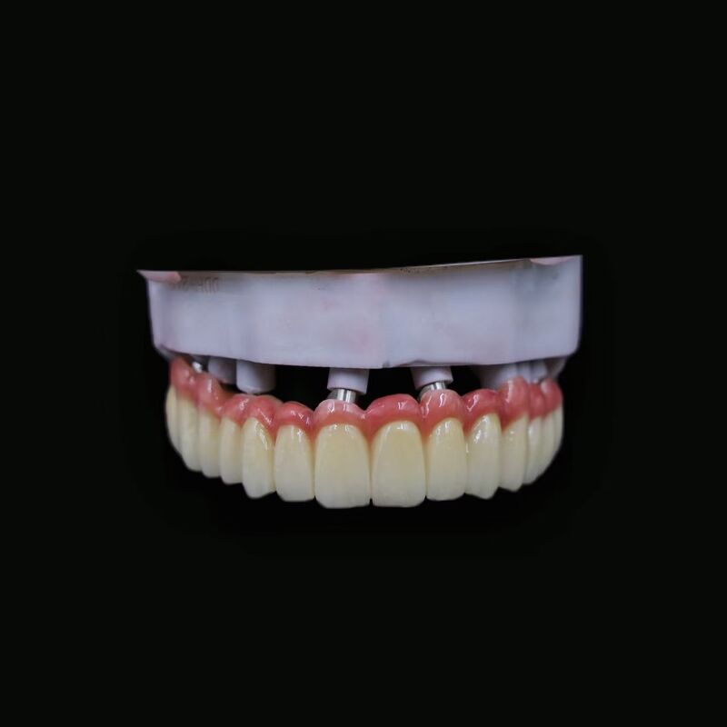 Precision Engineered Artificial Tooth Implant Offering Optimal Fit and Functionality for Effective Dental Rehabilitation