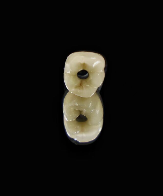 Corrosion Resistant Artificial Tooth Root Suitable for Multiple Dental Applications Providing Secure Implant Fixation