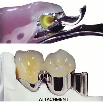 Preservación de dientes dentales para prótesis