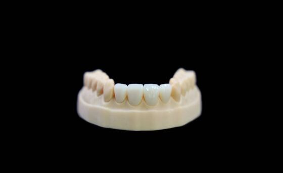 Disilicato di litio Tutto ceramico Emax Corona Restaurazione dentale Provata resistenza