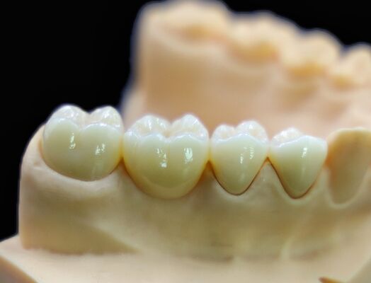 Metal Free Chinese Dental Lab CAD / CAM Full Zirconia Crown